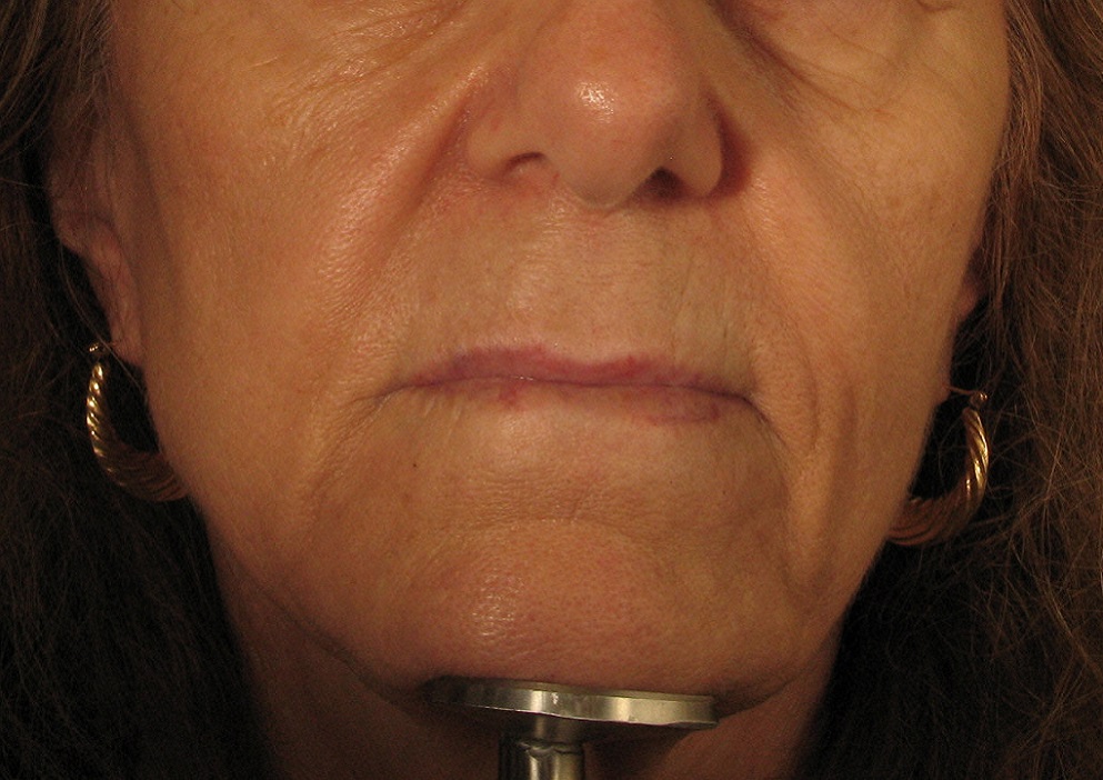 Before Sculptra Treatment.