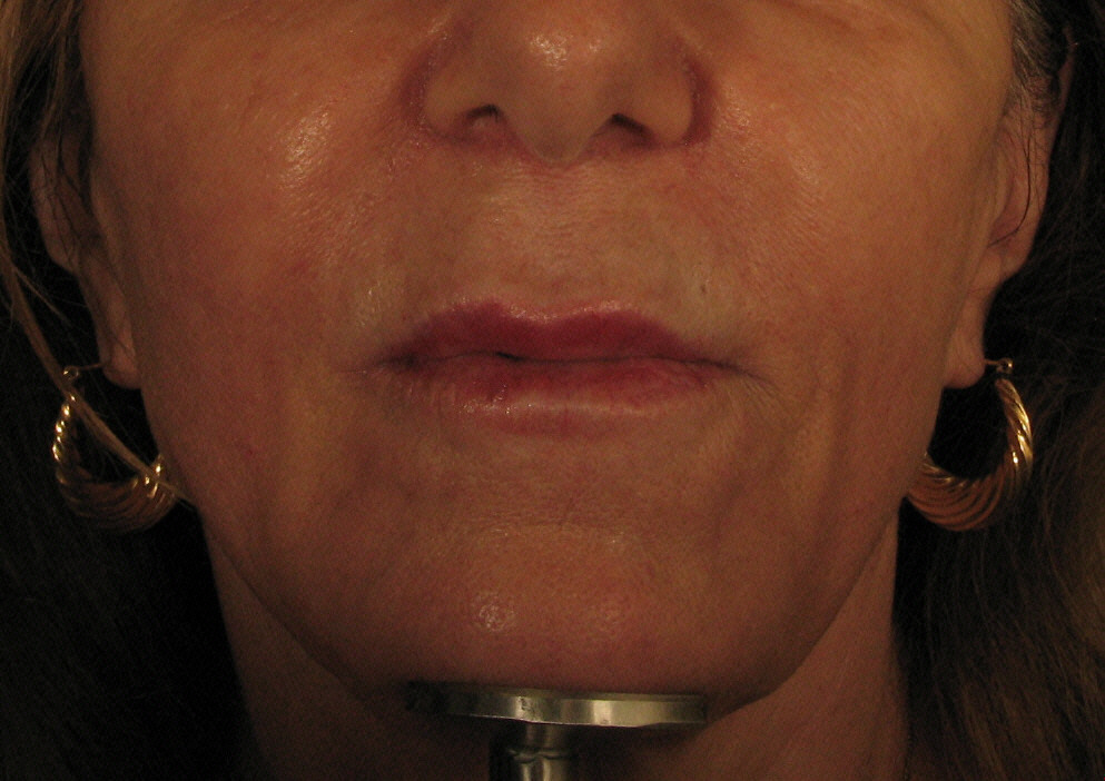 After Scultra Treatment.