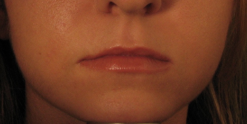 Before Juvederm Treatment.