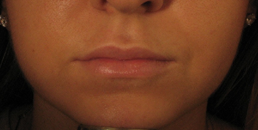 After Juvederm Treatment.