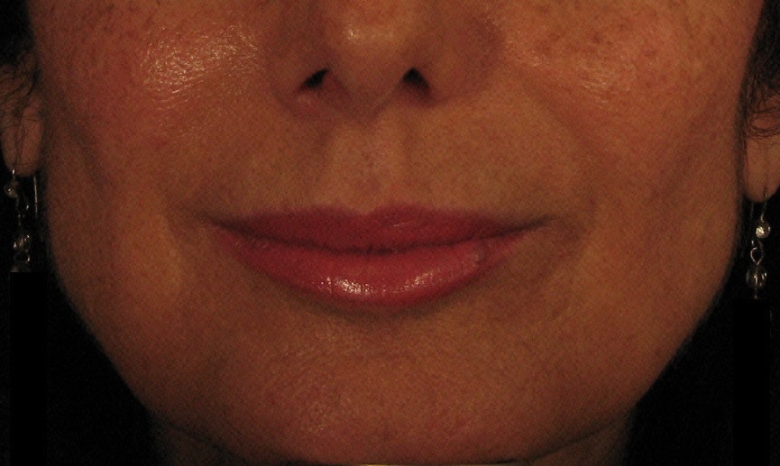 After Juvederm Treatment.