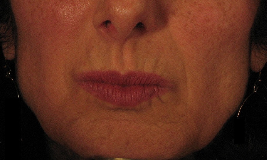 Before Juvederm Treatment.