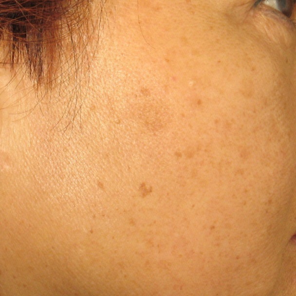 before Age Spots Treatment