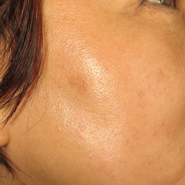 After Age Spots Treatment