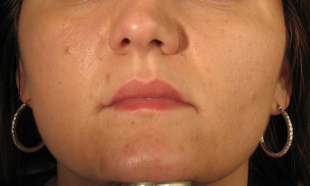 Before Acne Scar Treatment.