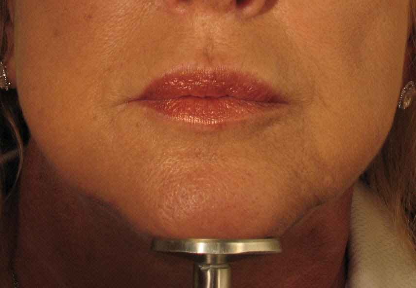 After Juvederm Treatment.