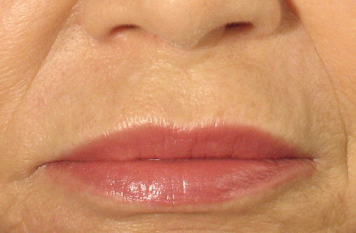 After Juvederm Treatment.