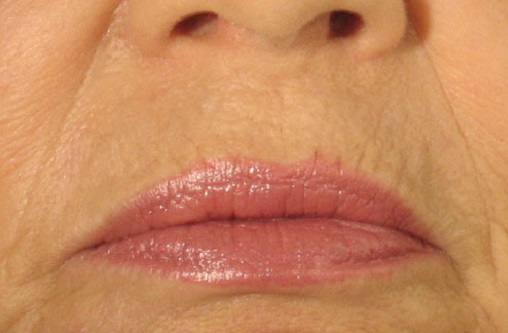 Before Juvederm Treatment.