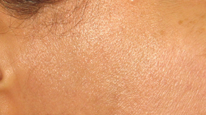 After Laser Hair Removal Treatment