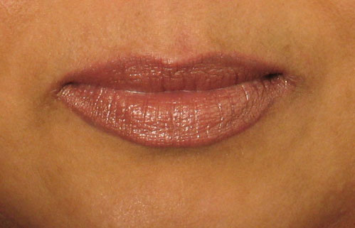 Before Restylane Treatment.