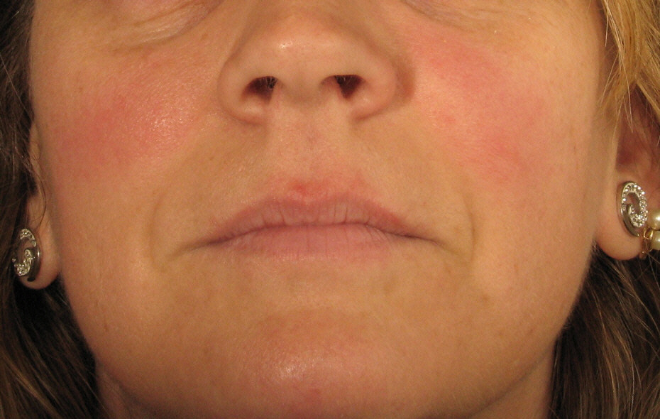 After Rosacea Treatment