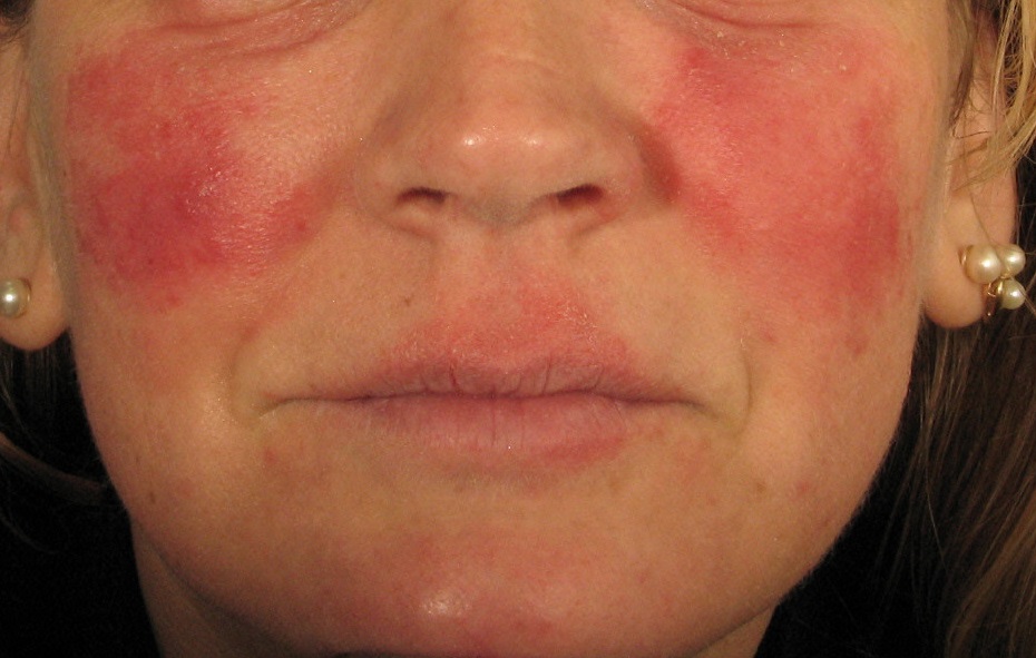 before Rosacea Treatment