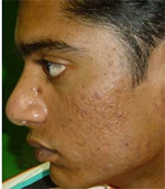 Acne Scar After