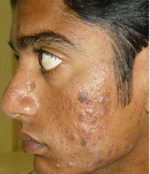 Acne Scar Before