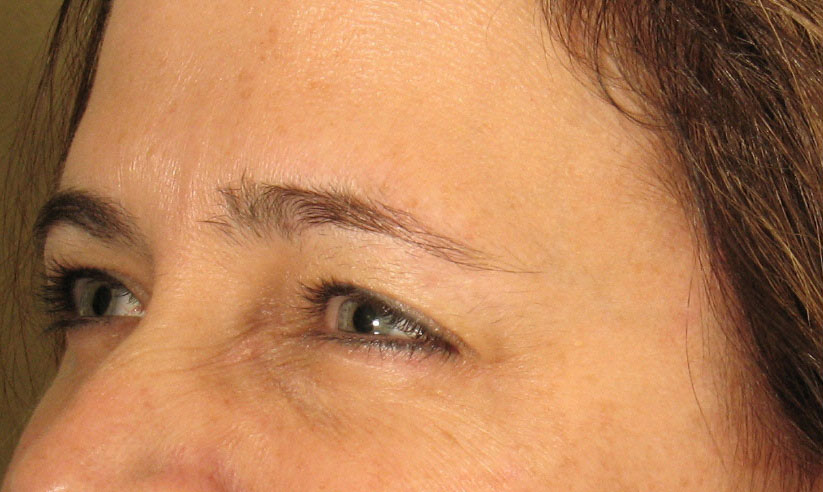 Crows Feet Botox After Photos