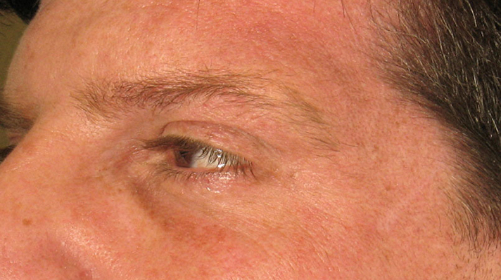 Botox Crows Feet After Photos