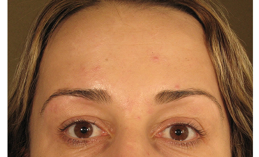 Botox Forehead After