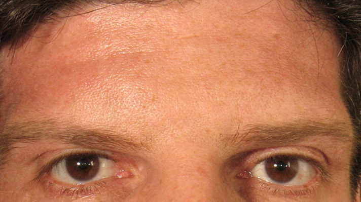 Botox Forehead After