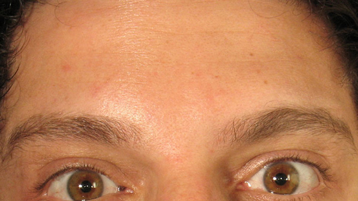 Botox Forehead After