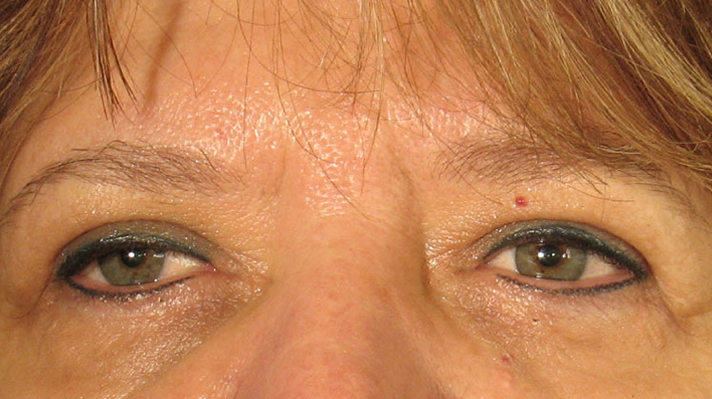 Frown lines after Botox