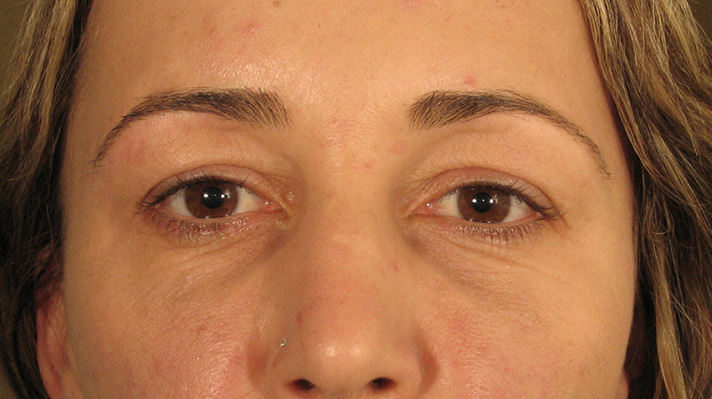 Botox After Photos