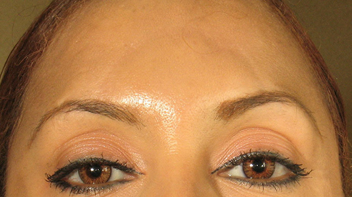 Botox After Photos