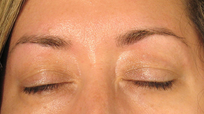 Botox After Photos