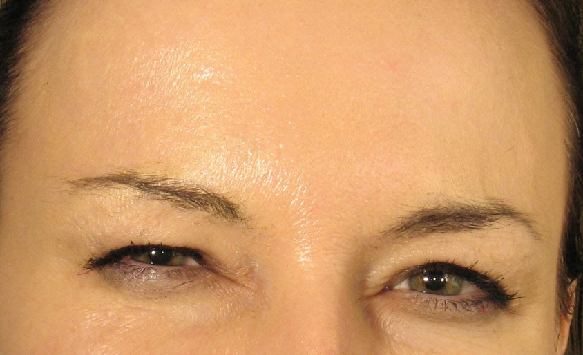 Botox Forehead After