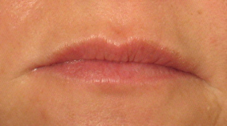 Botox Smokers Lines After