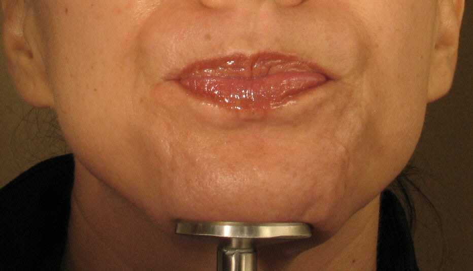 Botox After Photos