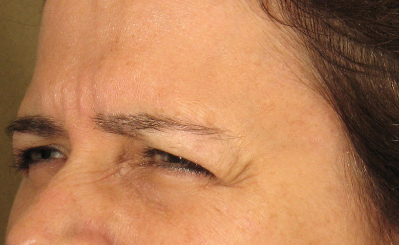 Crows feet Botox Before Photos