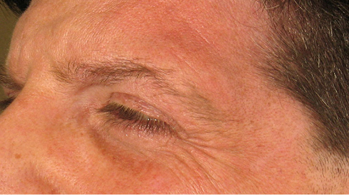 Botox Crows Feet Before Photos