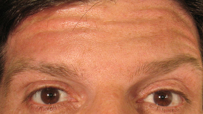 Botox Forehead Before