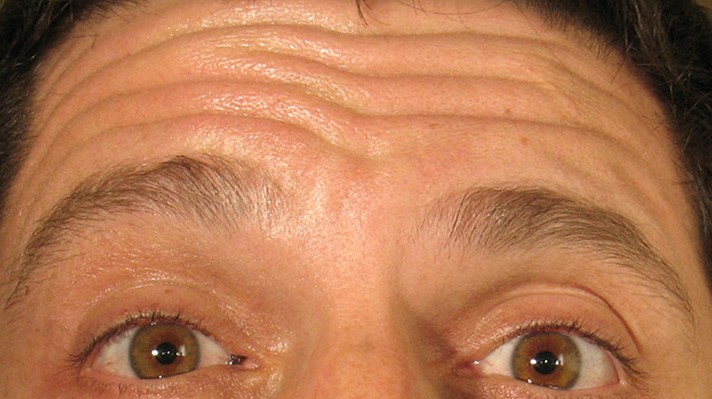 Botox Forehead Before