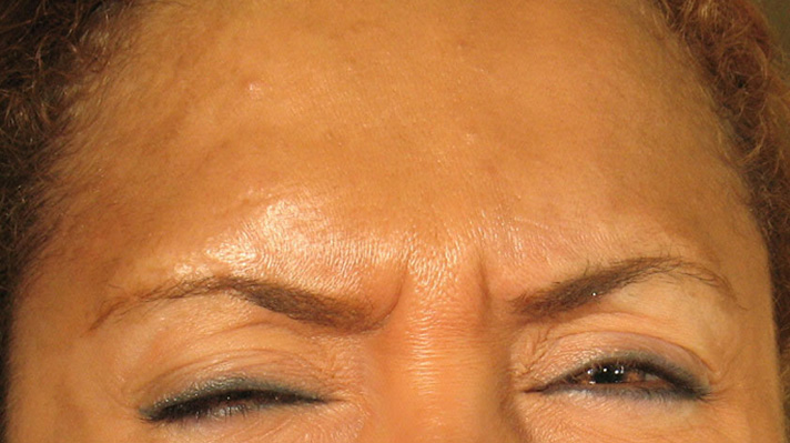 Botox Forehead Before