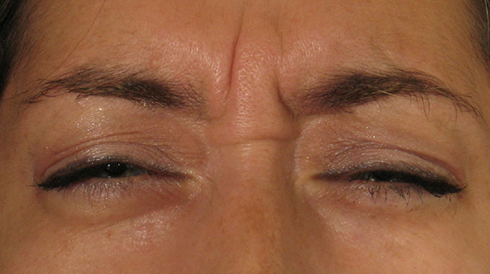 Botox Forehead Before