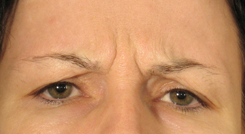 Botox Before Photo Woman