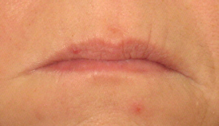 Botox Smokers Lines Before