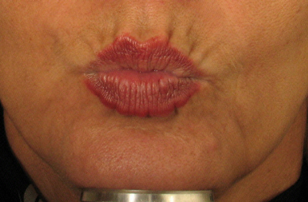 Botox Smokers lines Before