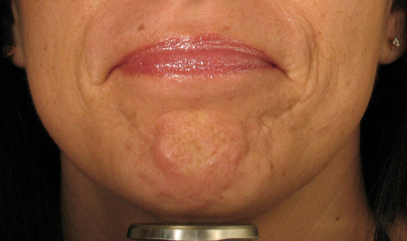 Botox Smokers Lines Before