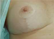 Breast Scar After