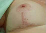 Breast Scar Before