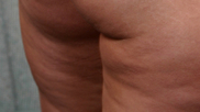 Example of Cellulite