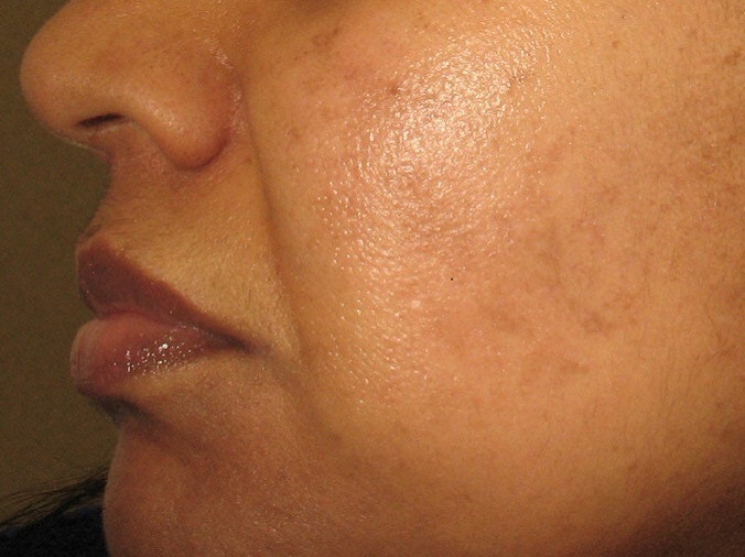 after age spot treatment