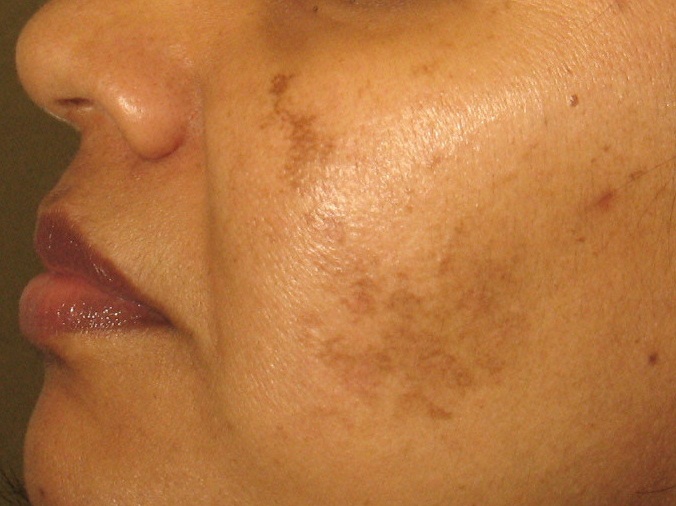 Before age spot treatment