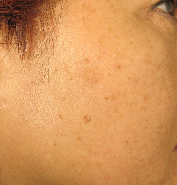 IPL at Vita Laser Medical Spa restores skin volume and creates lift to the face by stimulating collagen production.