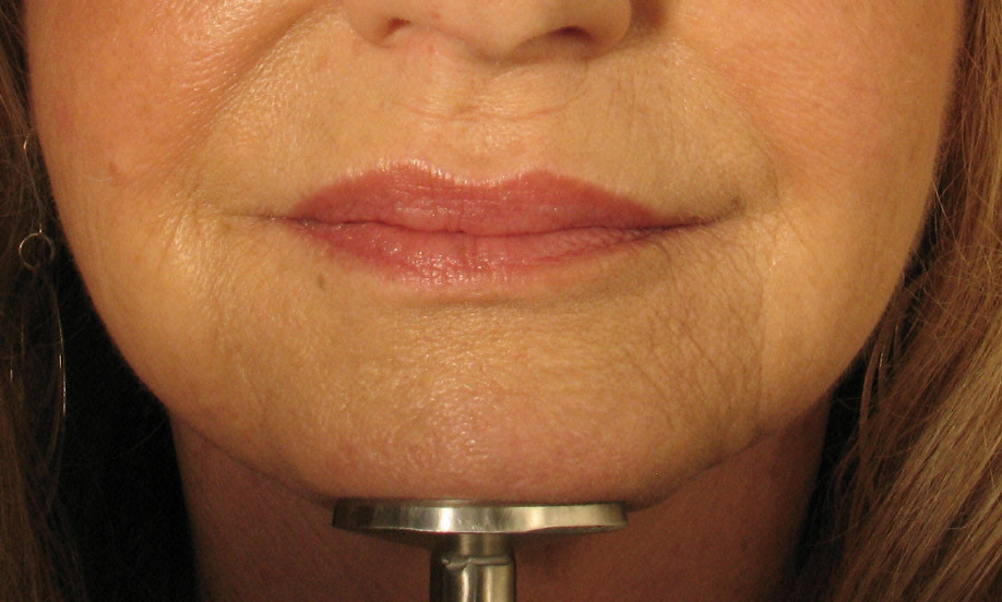 After Juvederm