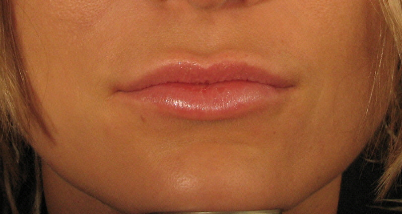 Lip wrinnkles with Juvederm treatment