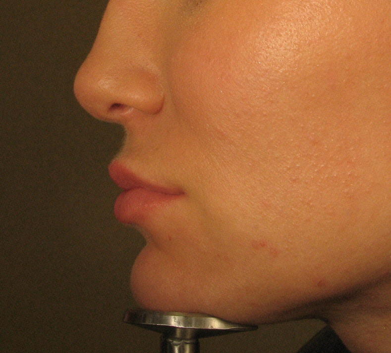 After Juvederm