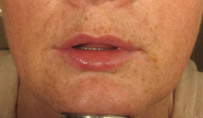 After Juvederm